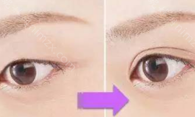 武汉吴小蔚医生做双眼皮修复技术怎么样?双眼皮修复技术案例分享