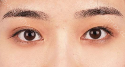 重庆华美李富强做双眼皮修复技术怎么样?口碑怎么样?