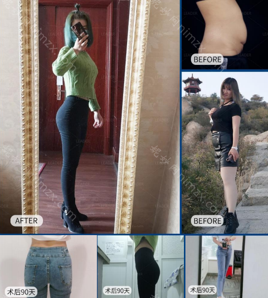 北京丽都高海燕主任吸脂怎么样?为什么会是较受欢迎的整形美容专家？