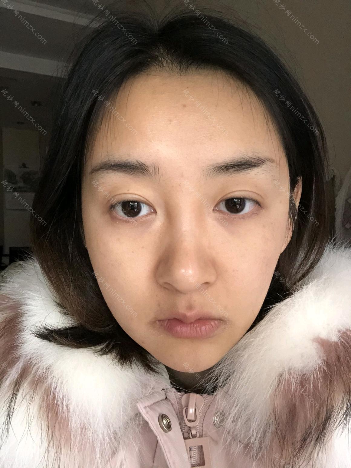 天津华中医疗美容医院做面部提升做的好吗?面部提升案例分享