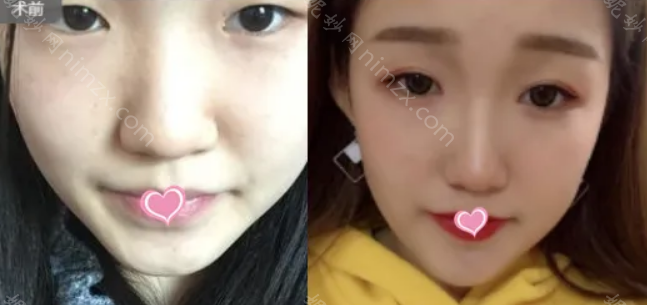 八大处整形医院靳小雷做的双眼皮修复价格是多少?这个价位算贵吗?