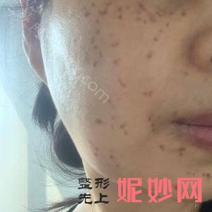 皮秒激光贵阳中医院皮肤病医院怎么样？做了之后效果好吗？