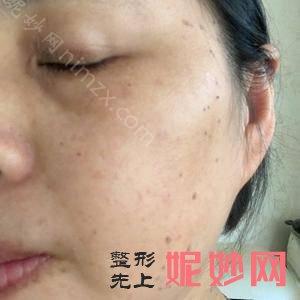 皮秒激光贵阳中医院皮肤病医院怎么样？做了之后效果好吗？