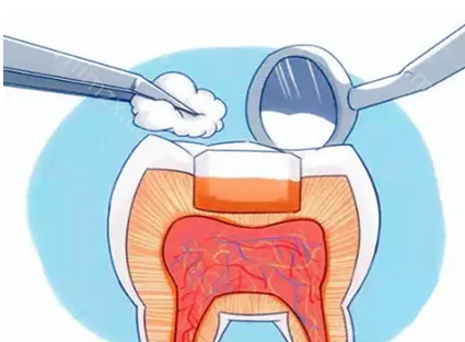 牙齿龋坏就一定要进行补牙吗？补牙的材料有哪些呢？