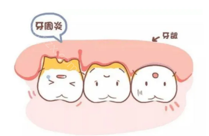 突然牙疼是什么原因，有没有哪些快速应对措施？