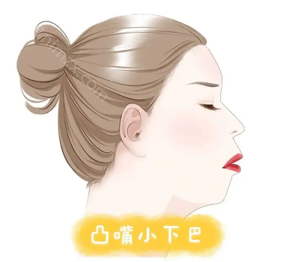 凸嘴矫正需要花费多少钱，造成凸嘴的原因是什么？