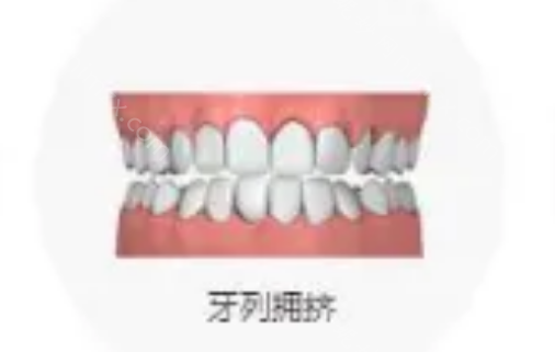 想判断是否需要矫正牙齿吗?参考标准的牙齿咬合图片