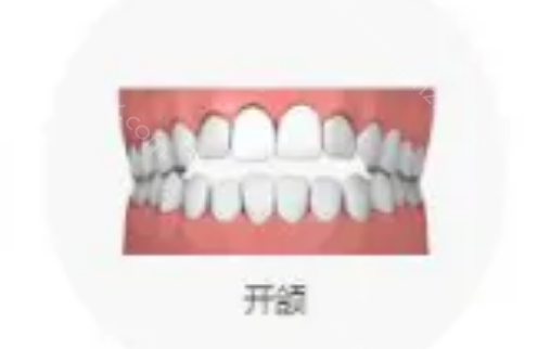 想判断是否需要矫正牙齿吗?参考标准的牙齿咬合图片