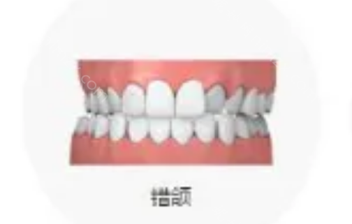 想判断是否需要矫正牙齿吗?参考标准的牙齿咬合图片