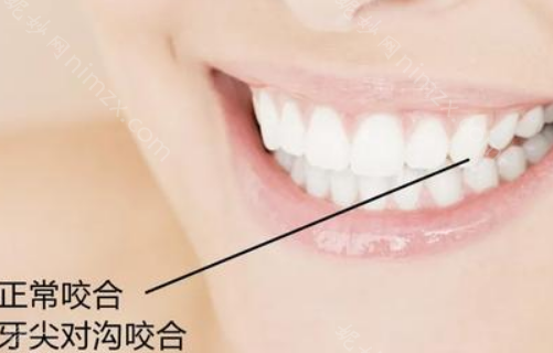 想判断是否需要矫正牙齿吗?参考标准的牙齿咬合图片