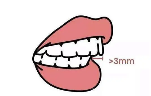 分享一张正常牙齿咬合图，教你判断自己的牙齿是否需要矫正