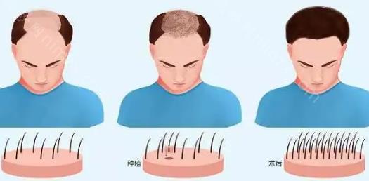 釜帝医疗整形医院做植发吗？带你了解这家医院真实技术实力！