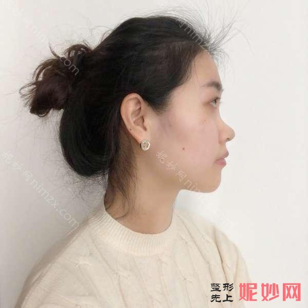 北京八大处杨欣做鼻子好吗?附上整形价目表|2022【价格表】~ 