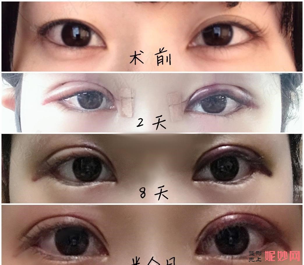 许昌辰星做双眼皮怎么样?附案例介绍!