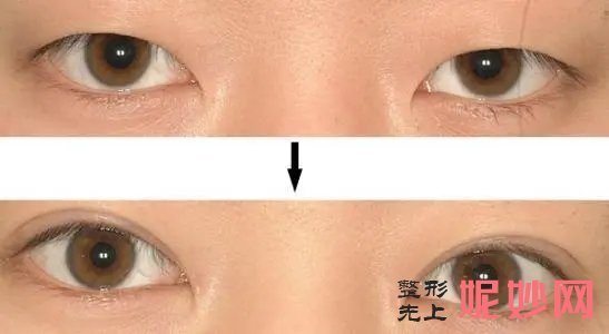 鞍山齐敏做双眼皮怎么样?附双眼皮真实案例!