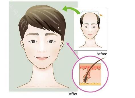 男生发际线种植要多少钱?男生m型植发价格大概是8500元起