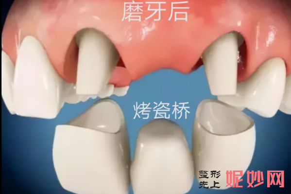搭桥和种牙哪个好？先了解概念再看其区别