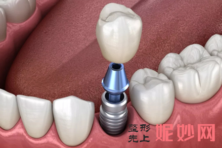 搭桥和种牙哪个好？先了解概念再看其区别