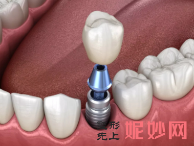 广州口腔医院种牙收费标准分享,便宜的种植牙1500+,贵的则15800+