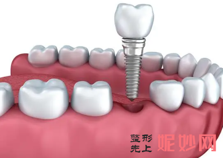 卡瓦和士卓曼哪个好?种植牙品牌名称一览:看各国的好牌子有哪些上榜