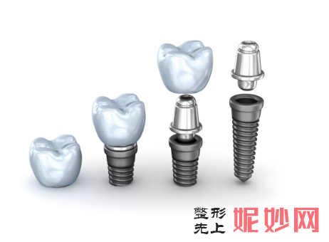 空军口腔医院种牙多少钱?瑞士ITI种植牙6860元起
