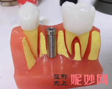 空军口腔医院种牙多少钱?瑞士ITI种植牙6860元起