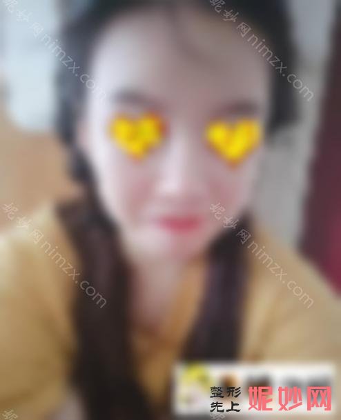 赵善军博士怎么样？医生详细介绍amp;面部抽脂手术病例