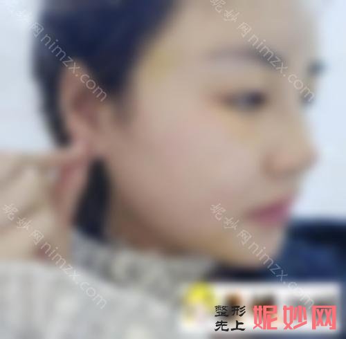 成都赵善军博士怎么样？小妹妹做面部抽脂两年后没有反弹！