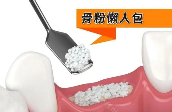 种植牙骨粉品牌排行榜亮相，种植牙骨粉选择指南分享
