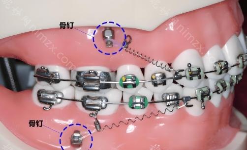 牙齿矫正中打骨钉的必要性、疼痛度及治