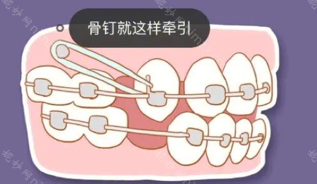 牙齿矫正中打骨钉的必要性、疼痛度及治疗过程详解