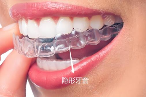 昆明华美美莱口腔种牙怎么样?种牙技术好,而且还擅长牙齿矫正，收费合理