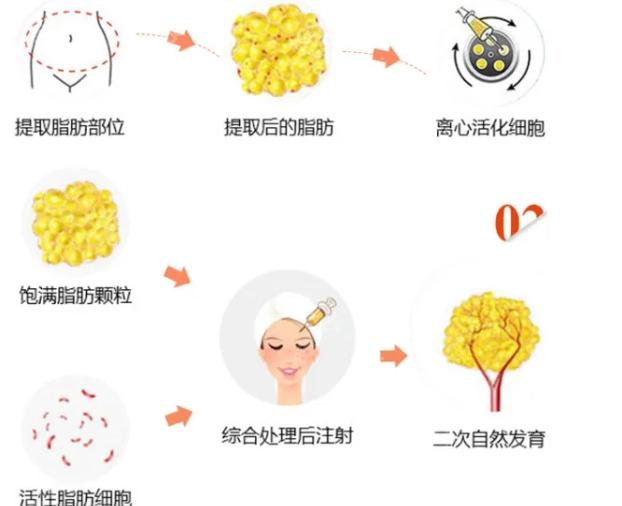 北京润美玉之光王明利收费并不贵，做吸脂/脂肪填充技术还不赖
