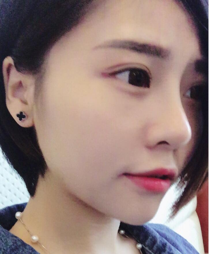 实拍真人做完垫鼻尖手术后的效果
