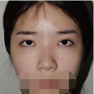 艺考生可以做垫鼻尖手术吗