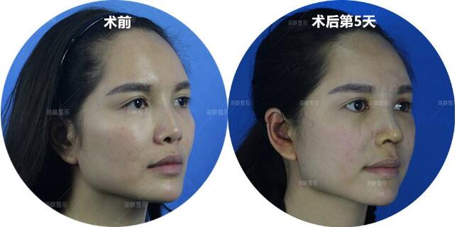 众多求美者分享垫完鼻基底的变化以及恢复照片