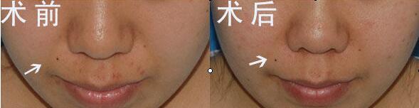 众多求美者分享垫完鼻基底的变化以及恢复照片