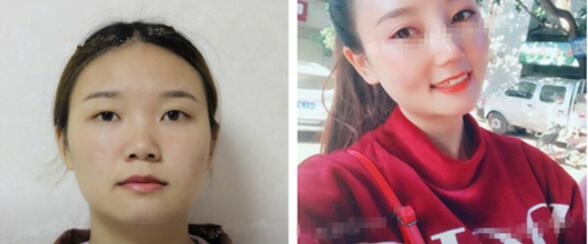 导致鼻小柱延长手术后发生并发症的原因