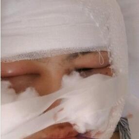 怕磨骨手术失败 找的上海九院磨骨专家梁平做