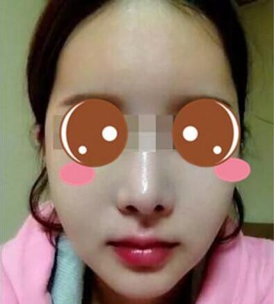 找上海华美李志海做的三维颧骨缩小术，看失败没