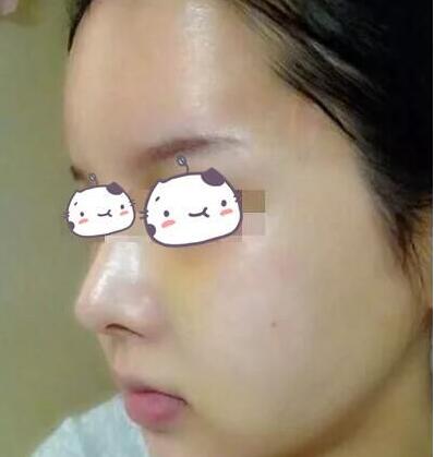 找上海华美李志海做的三维颧骨缩小术，看失败没