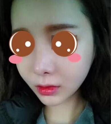 找上海华美李志海做的三维颧骨缩小术，看失败没