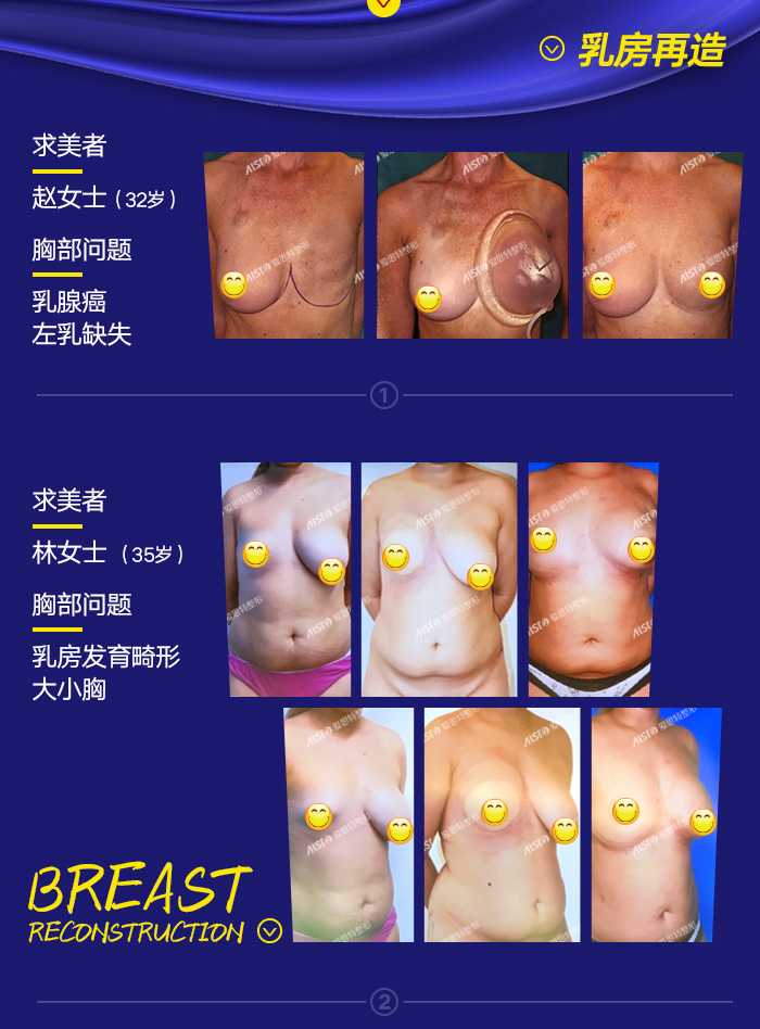 武汉爱思特 迈阿密非手术乳房再造术 效果逼真