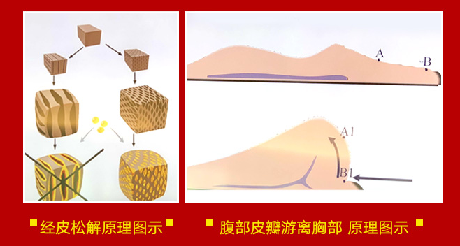 武汉爱思特 迈阿密非手术乳房再造术 效果逼真