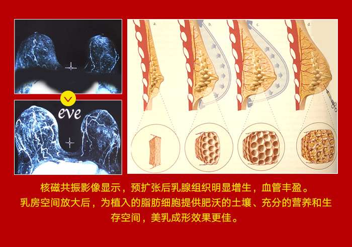 武汉爱思特 迈阿密非手术乳房再造术 效果逼真