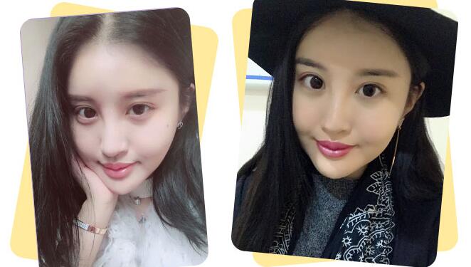 磨骨会死人吗?想找上海伊莱美李湘原做磨骨手术
