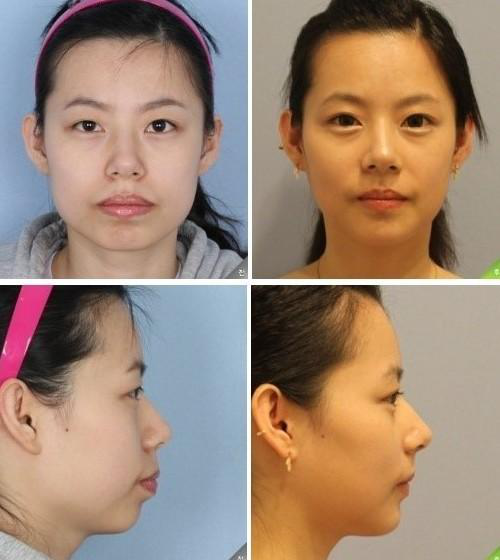 下颌角手术有多可怕，为什么连上海九院王涛医生都害怕它