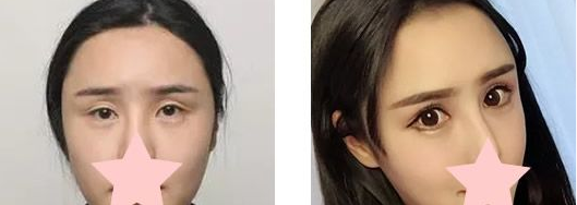 15天恢复自然，上海伯思立沈国雄实力美眼