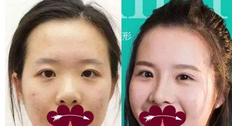 15天恢复自然，上海伯思立沈国雄实力美眼