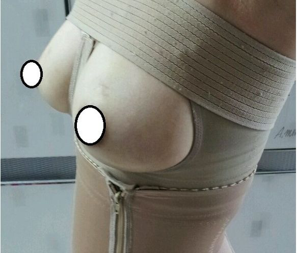 隆胸手术失败案例 杭州康美杜亚如医生修复隆胸手术